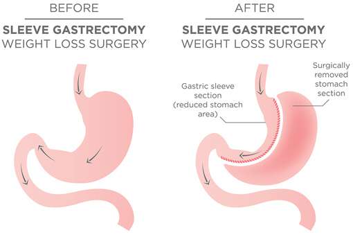 Gastric Sleeve Newcastle